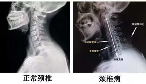 頸椎病怎么用理療瑜伽改善？